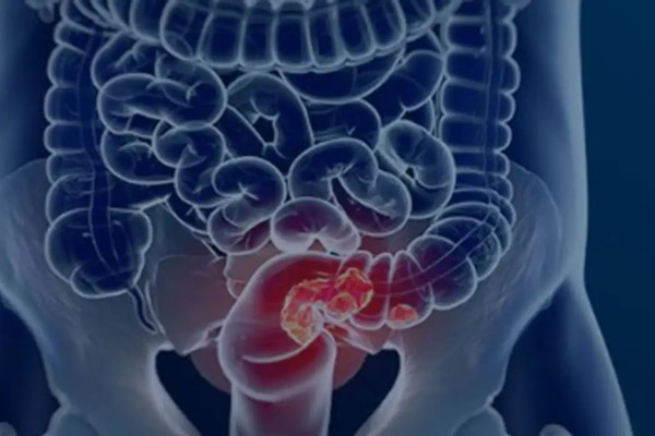 Estudo projeta aumento de 36% em mortes por câncer colorretal até 2040