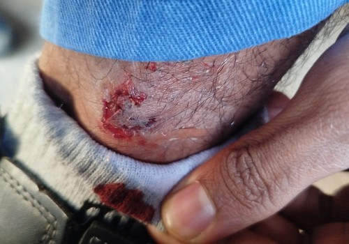Moradores do Alto da Serra se revoltam com constantes ataques de cães e cobram providências