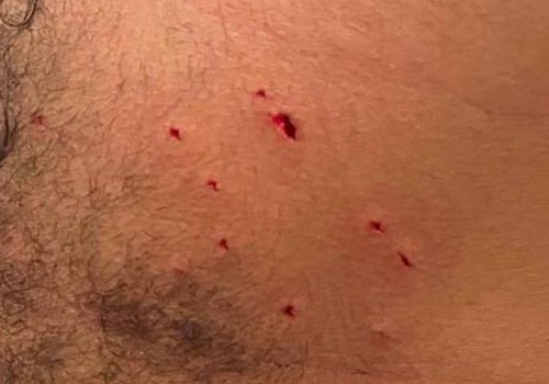 Jovem com tornozeleira eletrônica se auto lesiona após agredir a namorada, mas acaba preso em Patos de Minas